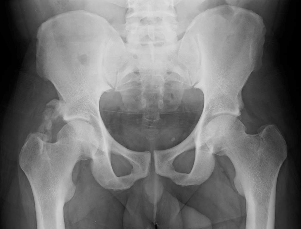 The Pelvis and Hip